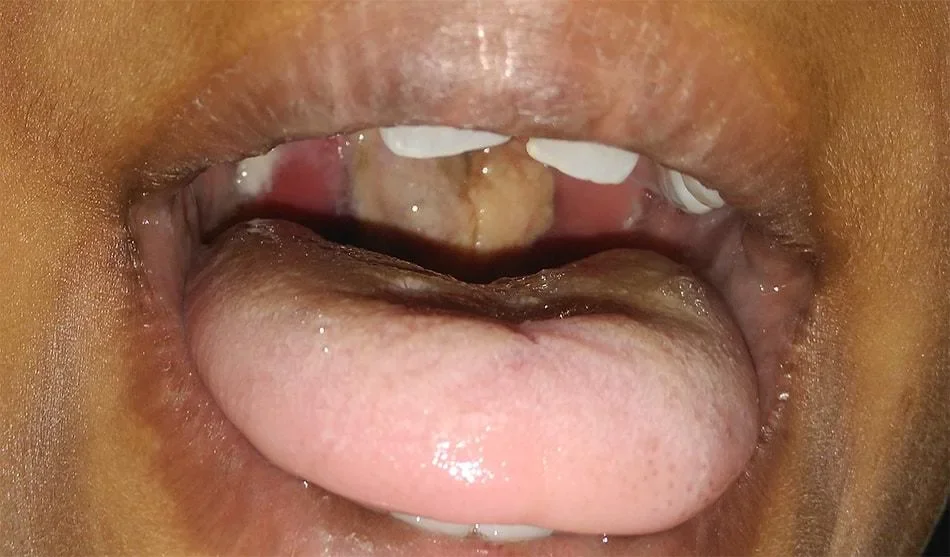 Across ANZ: Diphtheria Outbreak Causes Both Disease and Misinformation To Spread