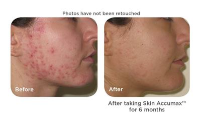 0000309_skin-accumax_400.jpeg