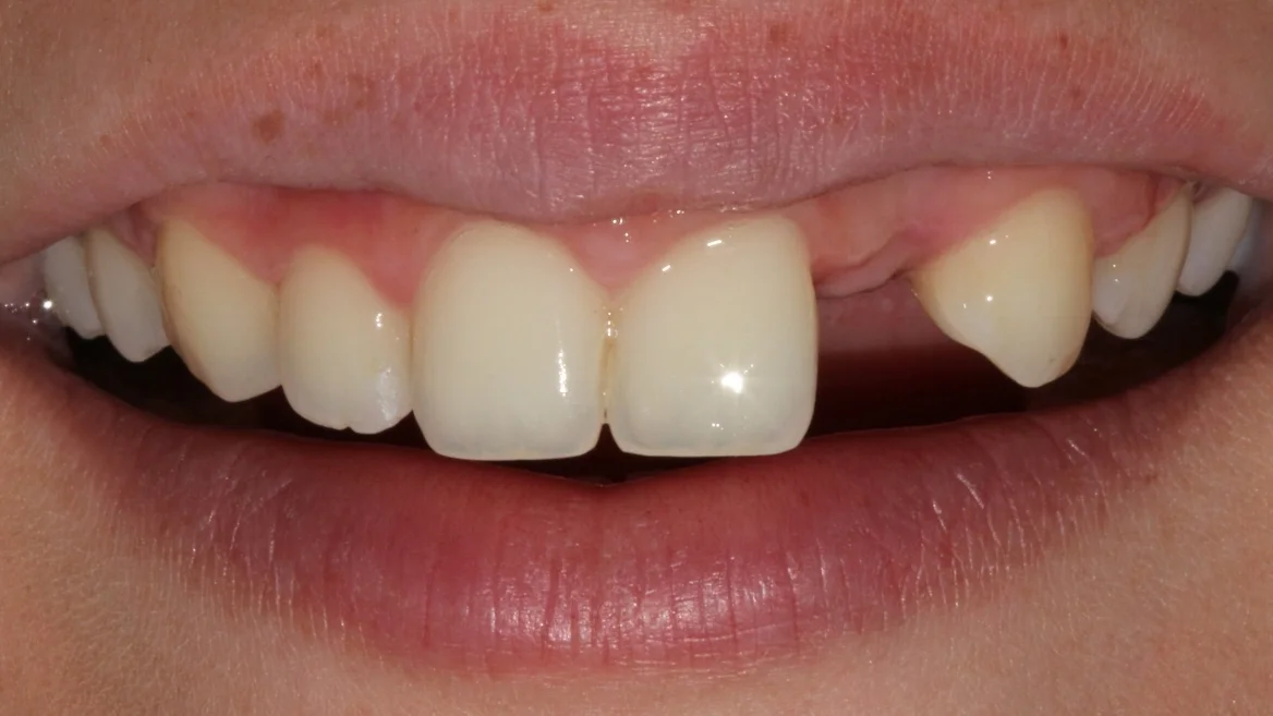 Initial (post-extraction)