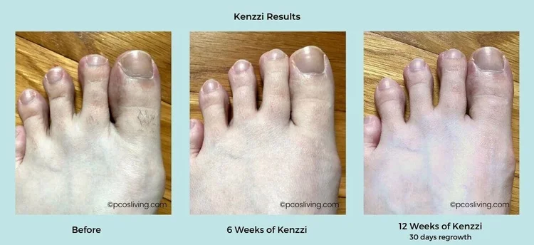 Laser Hair Removal for PCOS - Kenzzi Review — PCOS Living