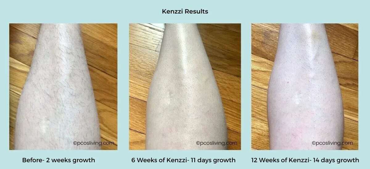 Laser Hair Removal for PCOS - Kenzzi Review — PCOS Living