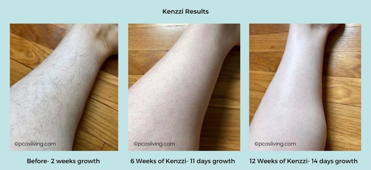 Laser Hair Removal for PCOS - Kenzzi Review — PCOS Living