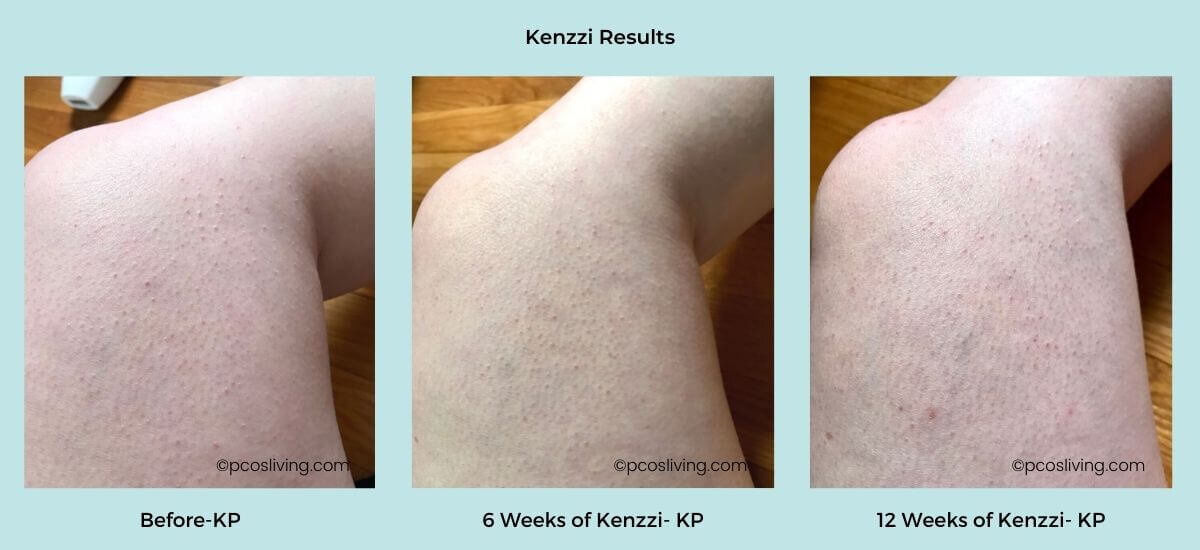 Laser Hair Removal for PCOS - Kenzzi Review — PCOS Living