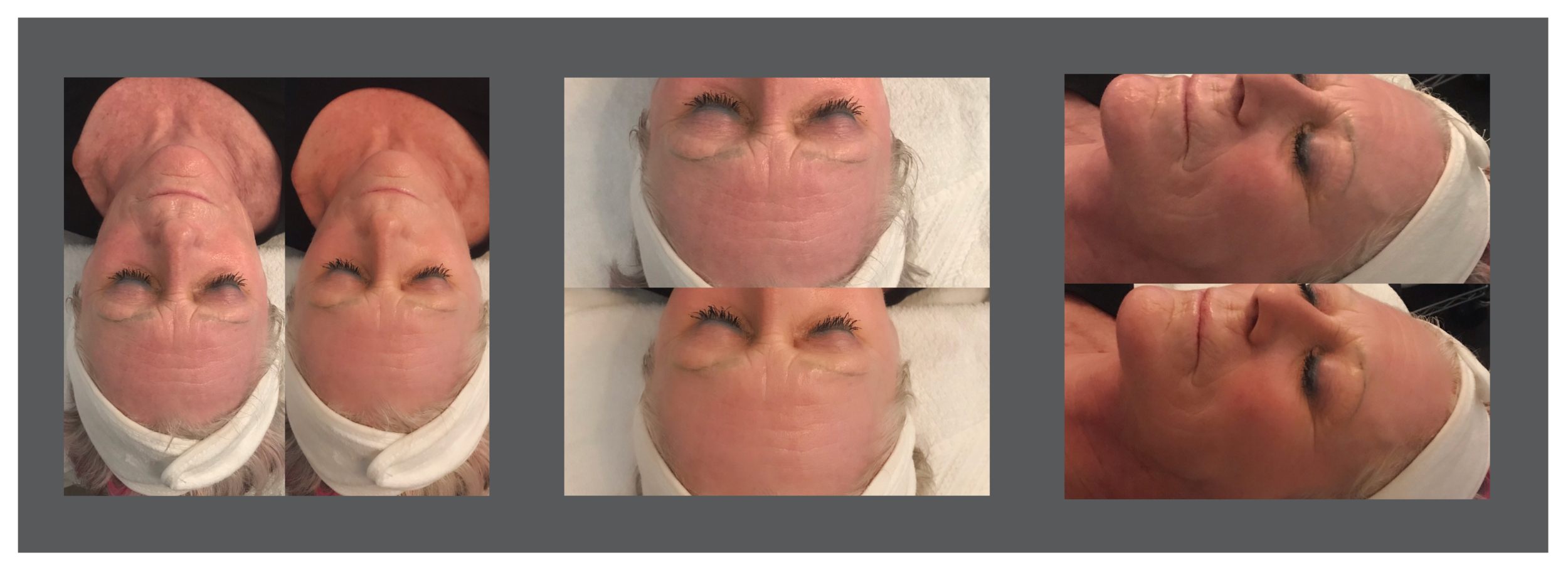 Cryoskin-Facial-VD.png