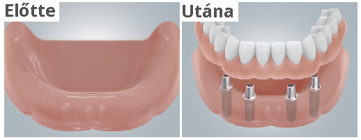 kapcsos_mufogsor_implantatumokra_helyezve.png