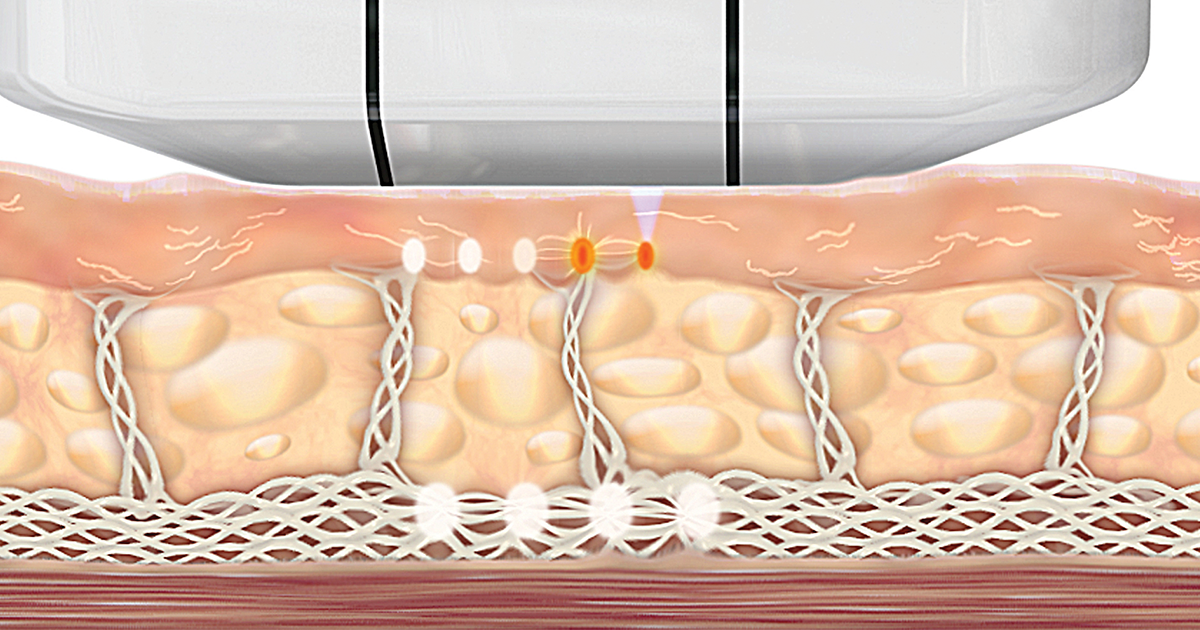 Ästhetische Gesichtsbehandlung | Hautstraffung mit Ultraschall | Ultherapy®