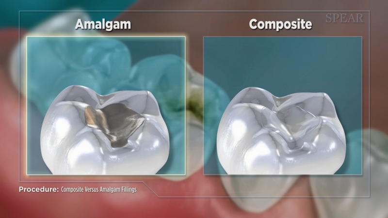 Amalgam vs. Composite