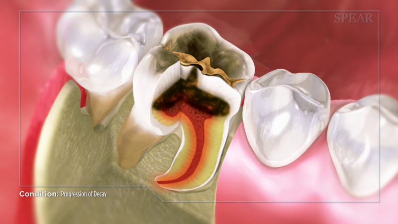 Progression of Cavities