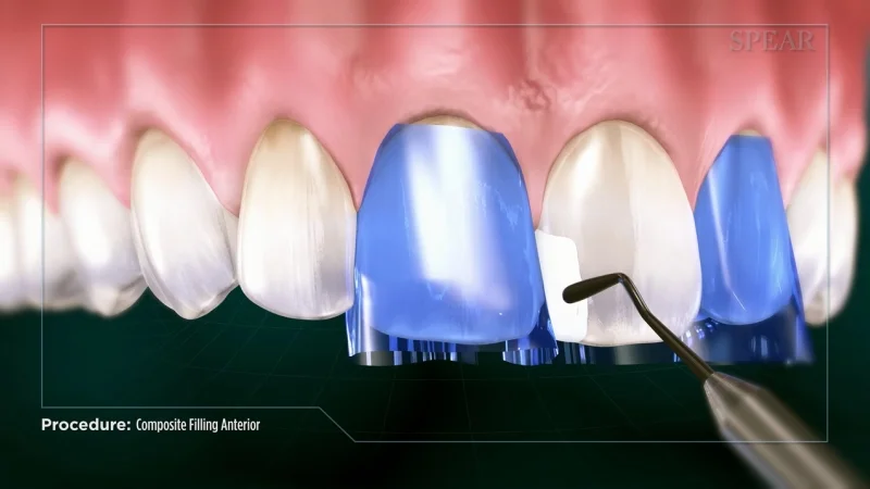 Filings on Front Teeth