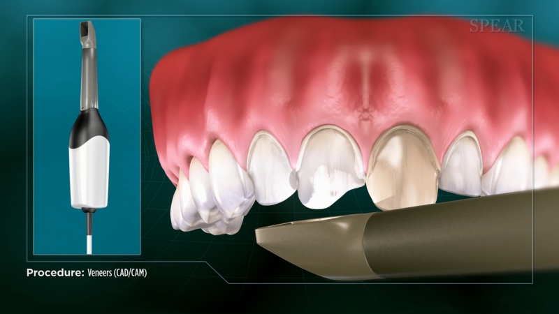 Veneers