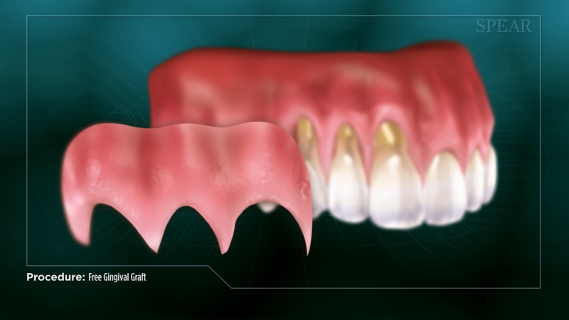 Free Gingival Graft