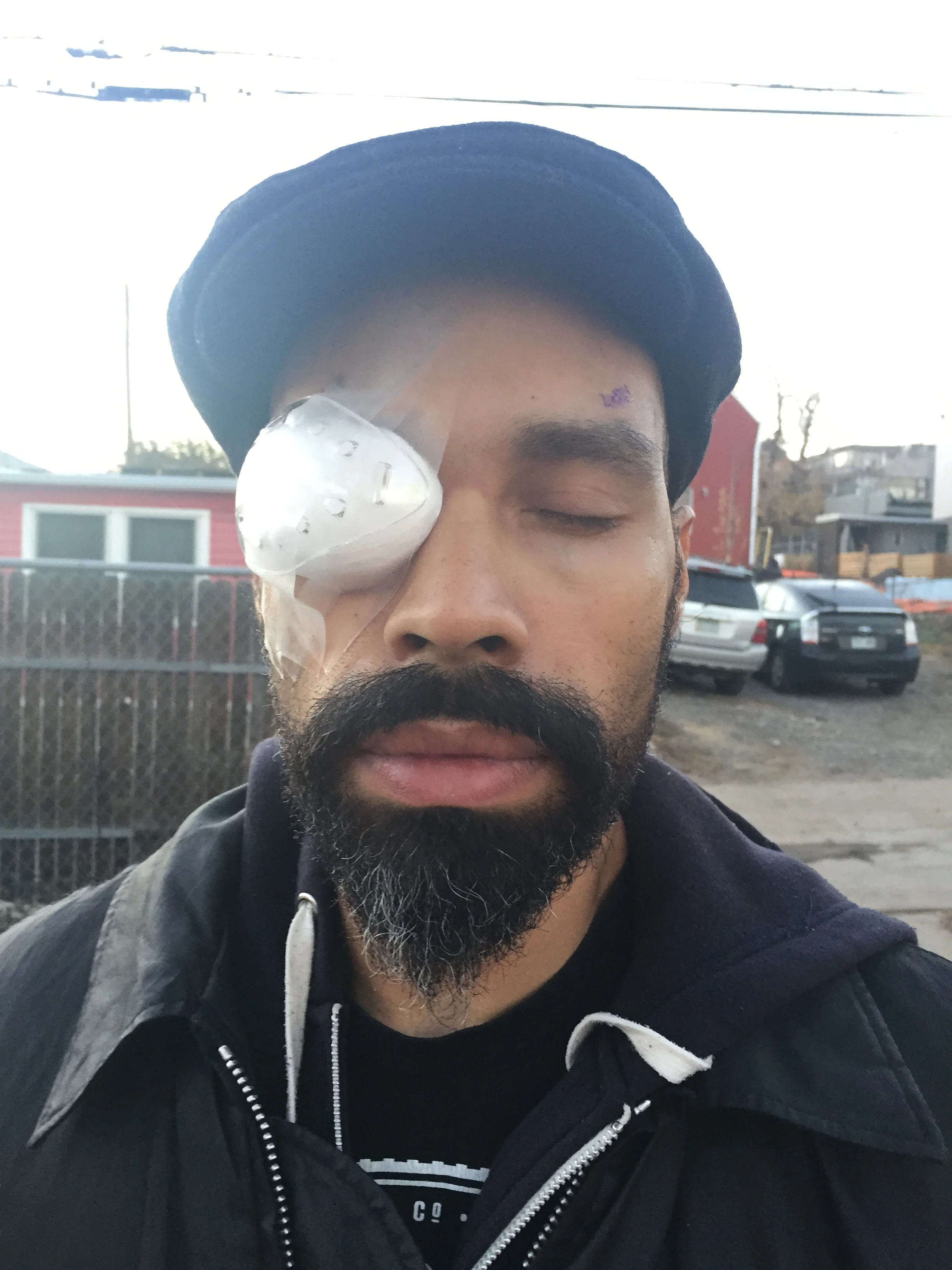 I had to wear this balloon shaped eyepatch for a day and a half.
