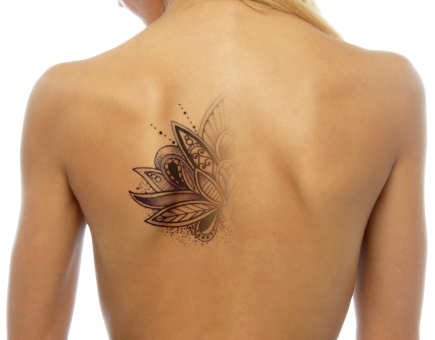 tattoo-removal.png