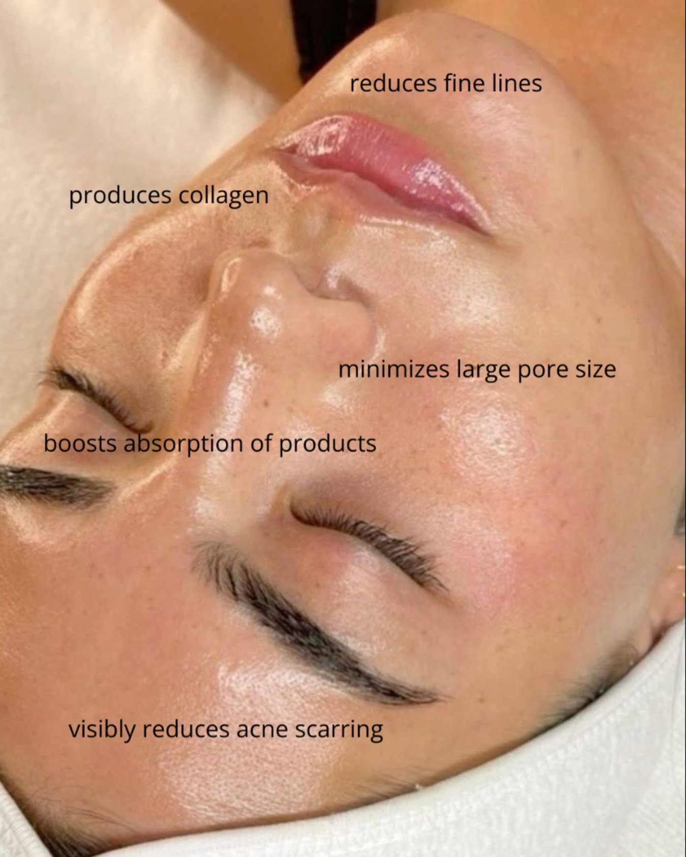 The best way to rejuvenate your skin naturally 🤍
Microneedling stimulates your body&rsquo;s own collagen production to:
✔️ Smooth fine lines &amp; wrinkles
✔️ Fade acne scars &amp; hyperpigmentation
✔️ Shrink enlarged pores
✔️ Improve skin texture &