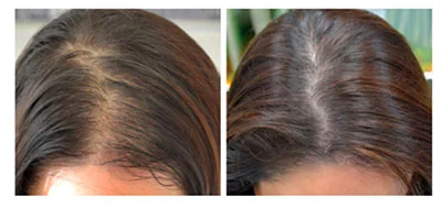 Results after four months of taking Nutrafol PLUS four PRP treatments. Photo is courtesy of Julia Russak, M.D . a dermatologist in NYC.