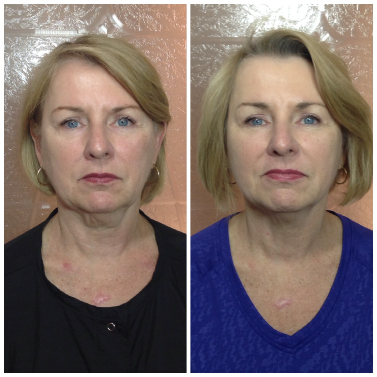 LPG Face Endermologie — Wraptured