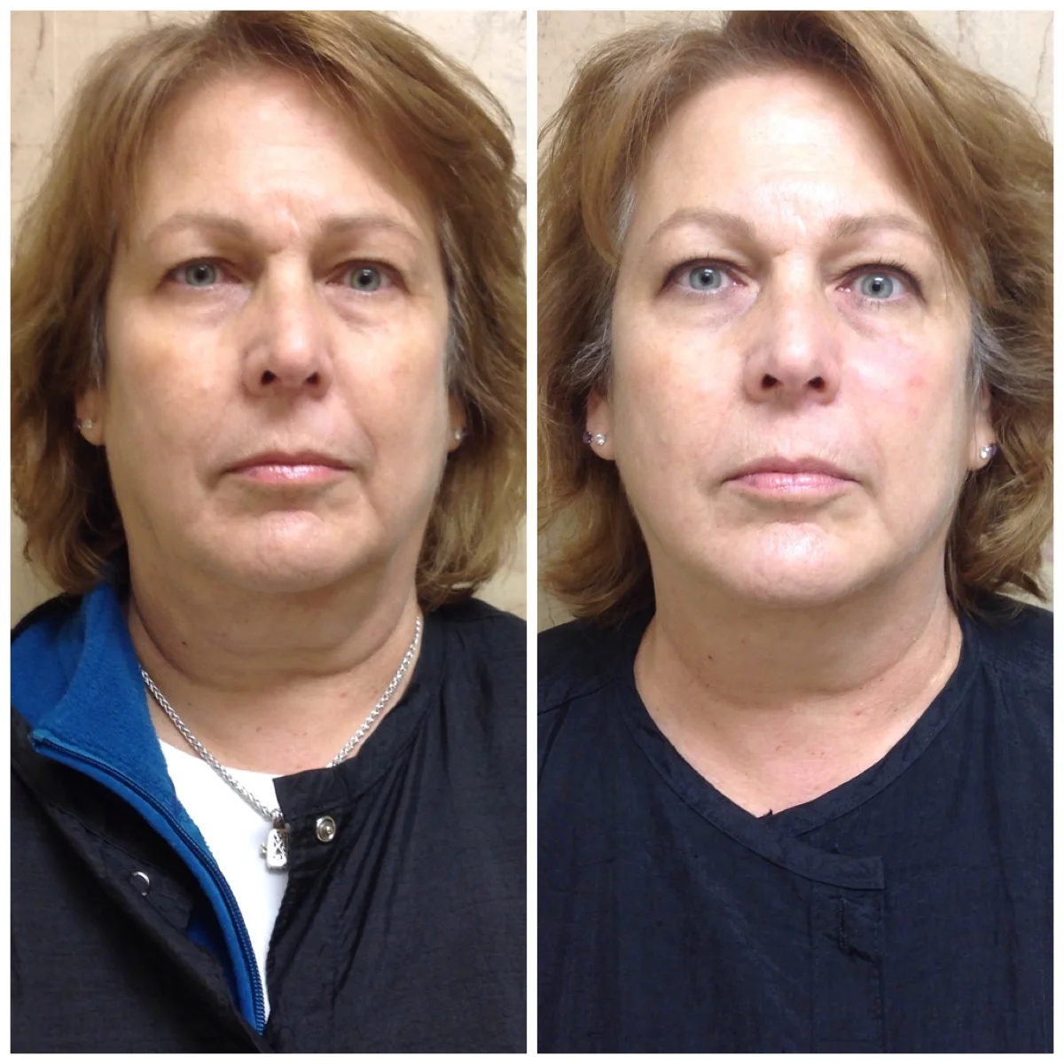 LPG Face Endermologie — Wraptured