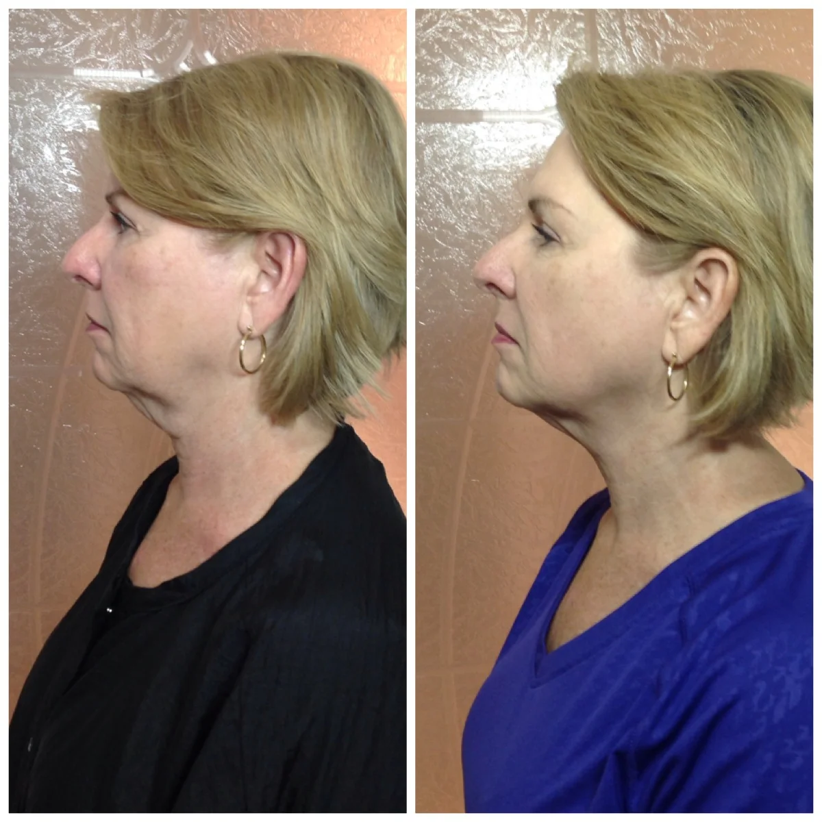 LPG Face Endermologie — Wraptured