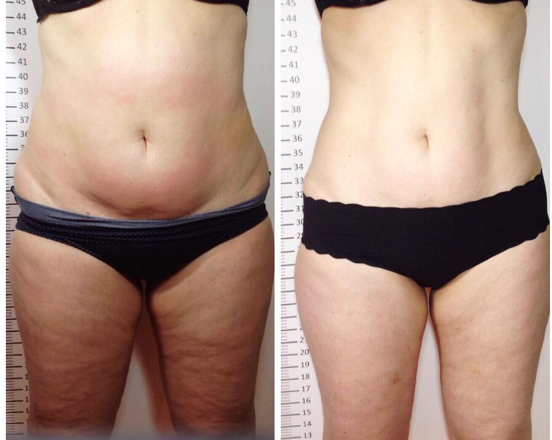  Astounding results combining LPG Integral with Inch-Loss Body Wraps!   