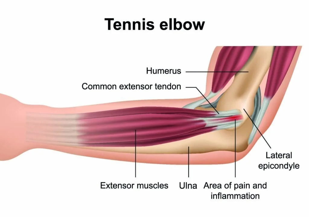 Tennis Elbow Prevent Tennis Elbow Tennis Elbow Stretch Treat