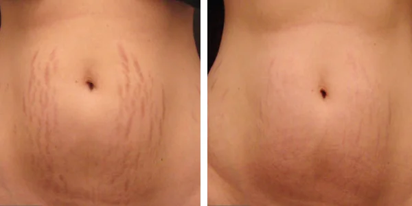 Microneedle-stretch-marks.jpg