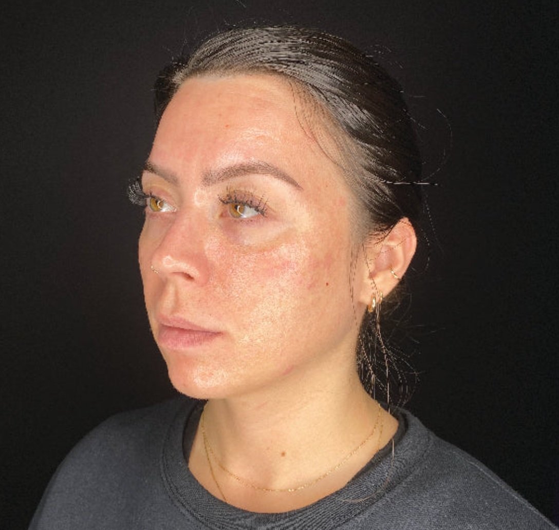 Post TX after Exosome Application