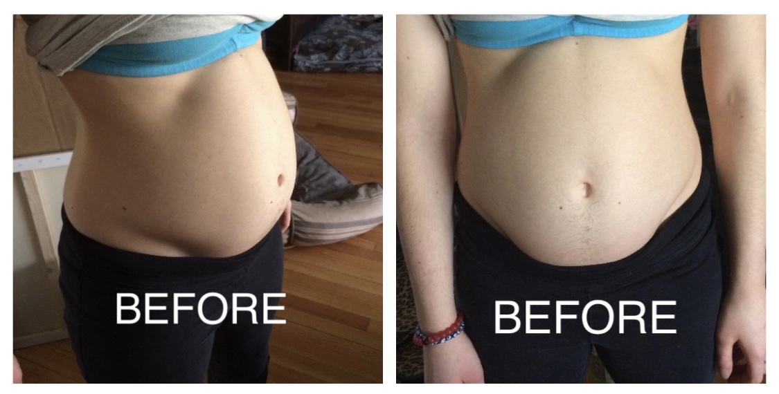 Abdominophrenic Dyssynergia And Pelvic Floor Dysfunction Zion Physical Therapy