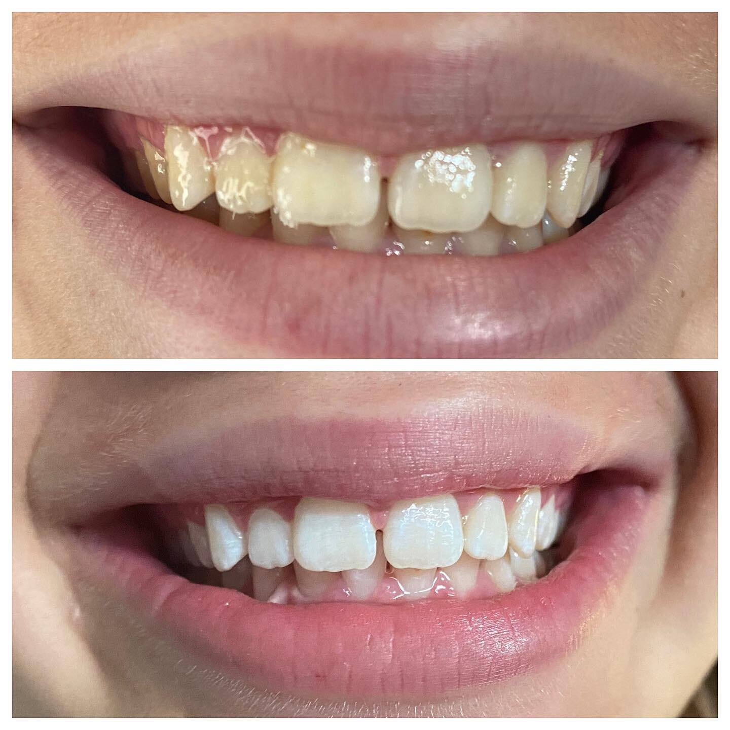 My daughters teeth after a mini treatment. Younger people get whiter quicker because they don&rsquo;t have as much staining! #teethwhitening #esthetician #spa #selfcare #brightsmile