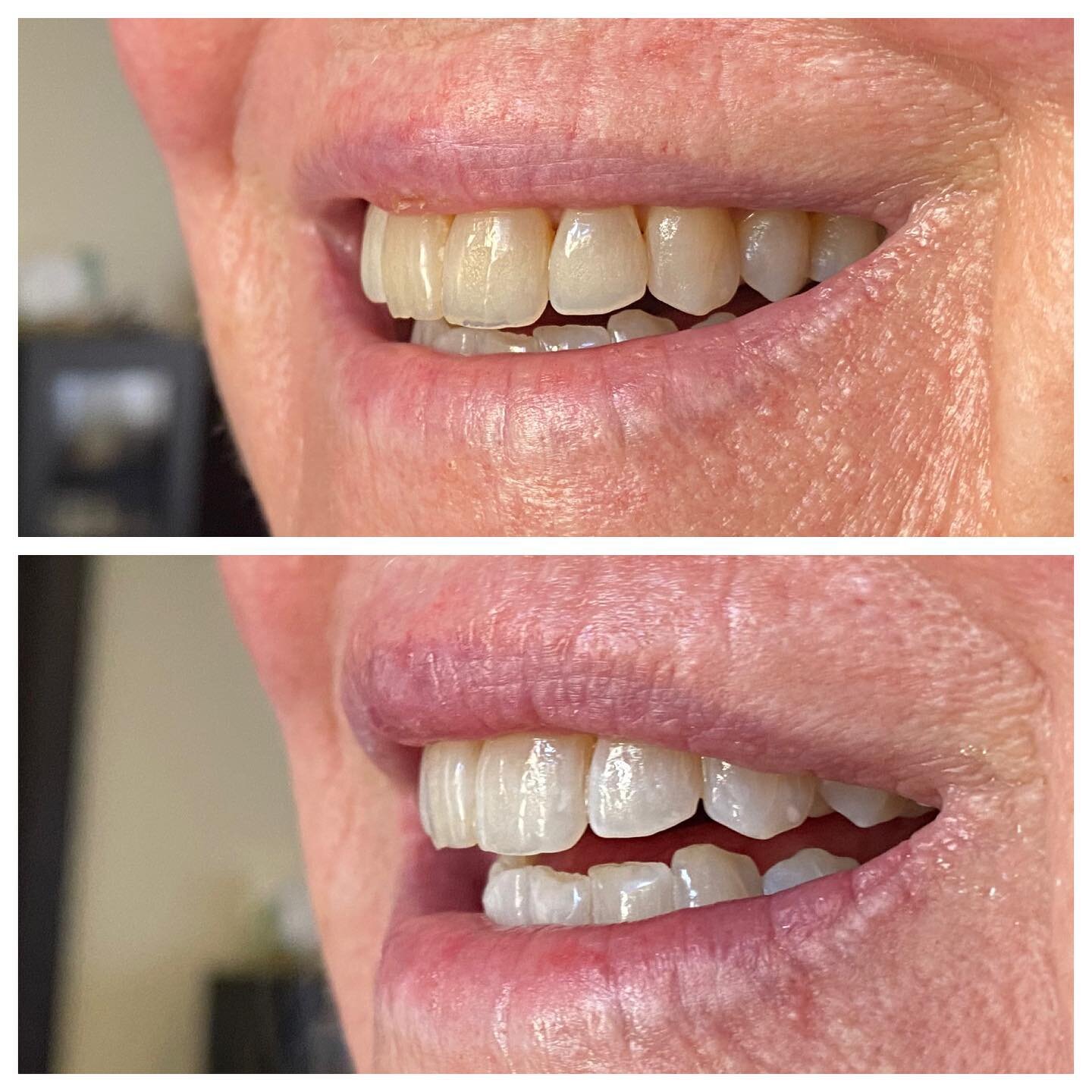 One session and already a world of difference! 
.
.
.
.
#teethwhitening #skincare #beauty #sancarlos #estylife #esty #brightsmile