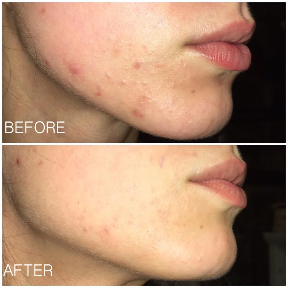 Vitalize Chemical Peel