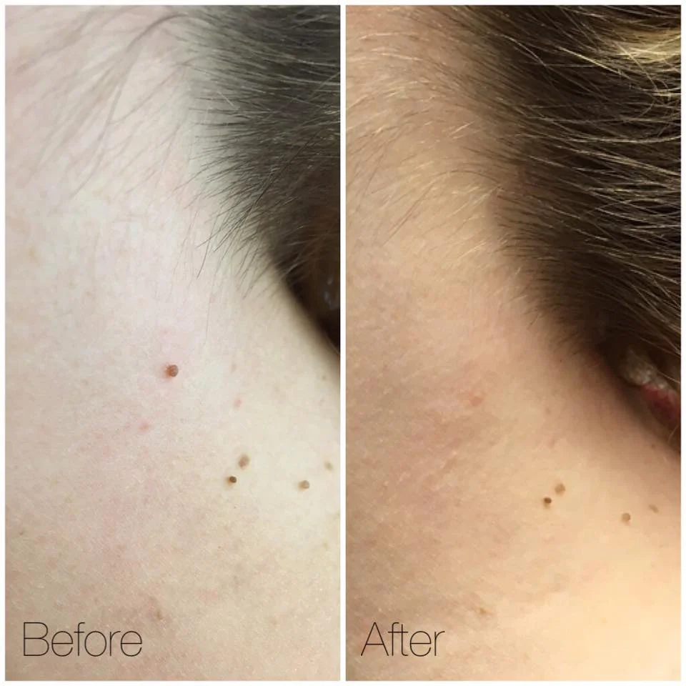 CryoClear Skin Tag Removal