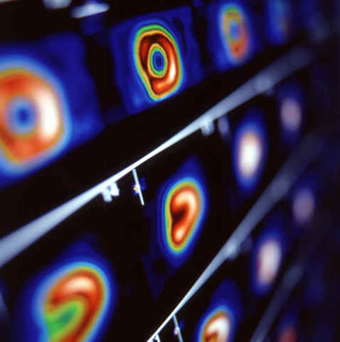 Nuclear Myocardial Perfusion.jpg