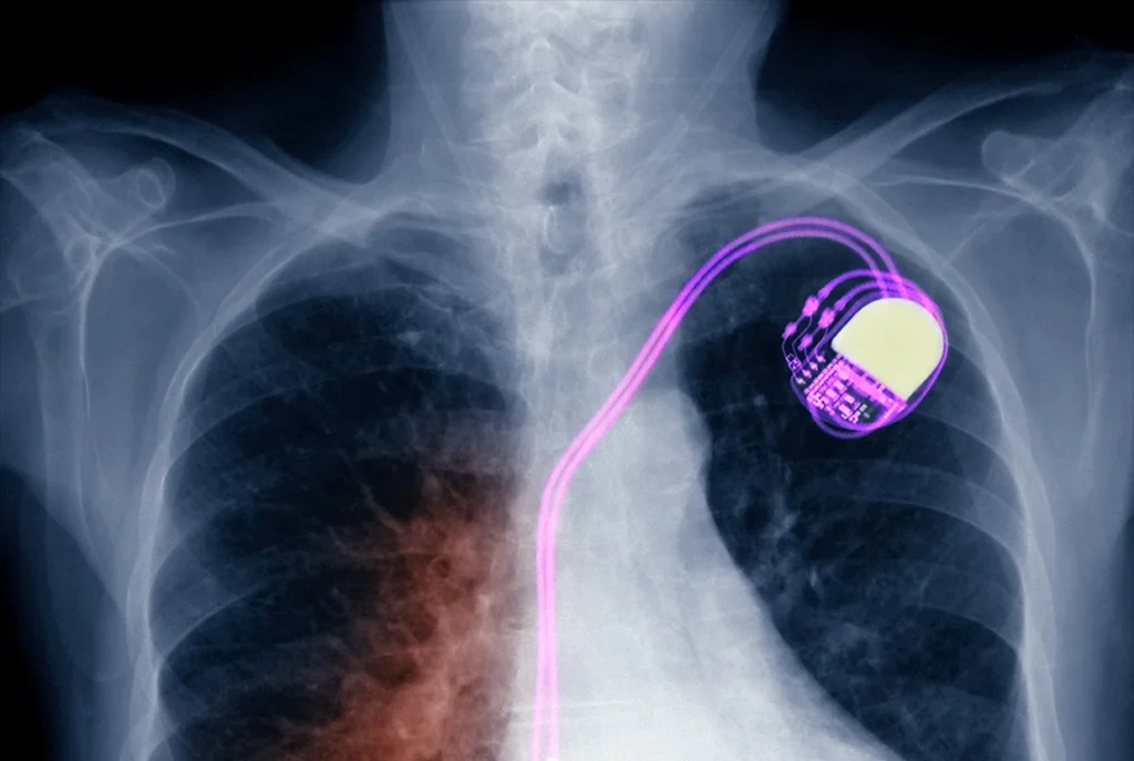 CXR pacemaker (purple).jpg
