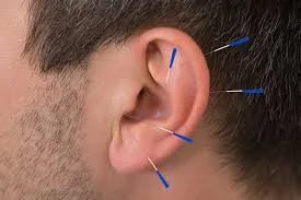 Ear (auricular) acupuncture