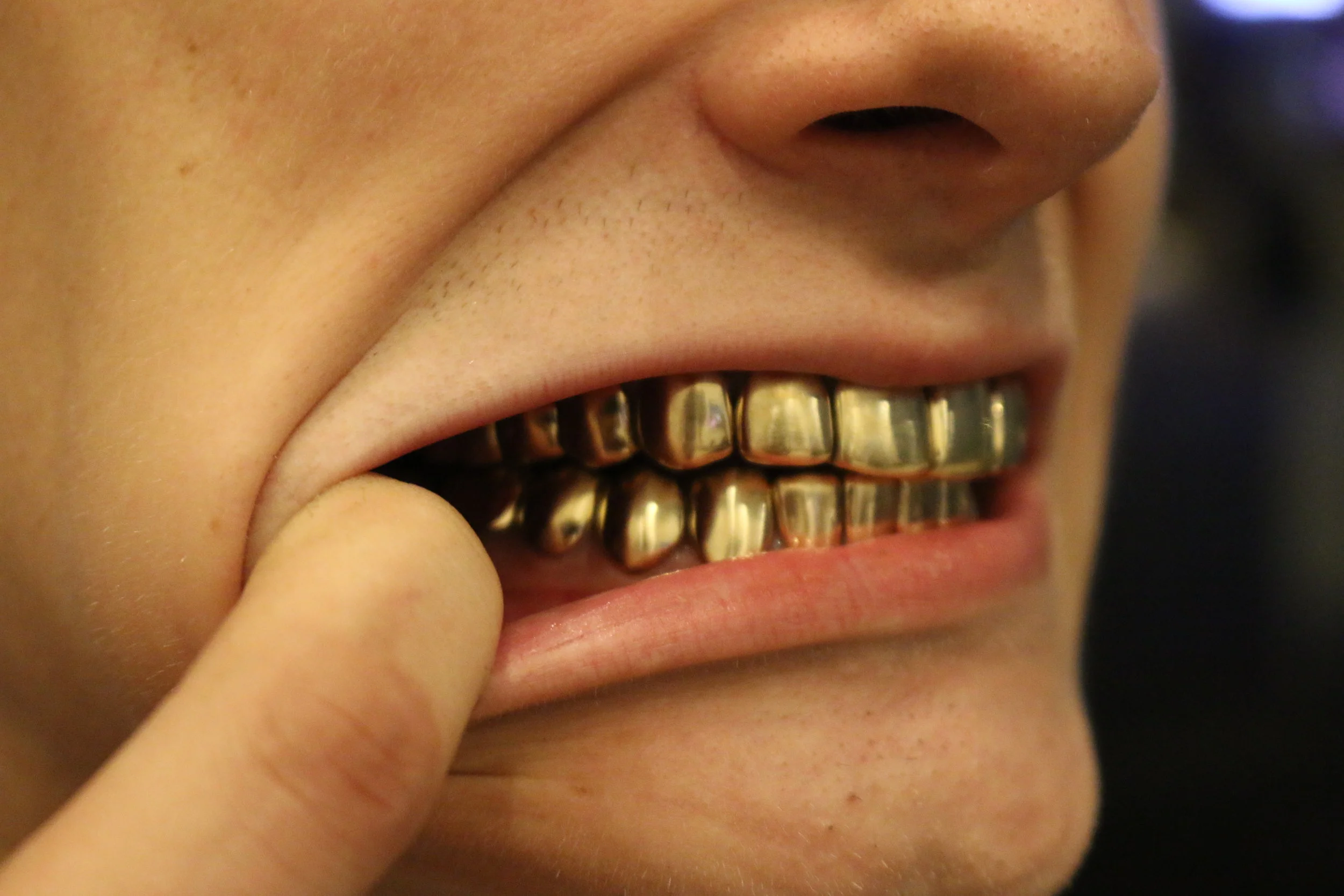 Close-up of a person's mouth showing gold grillz on upper and lower teeth, with someone’s finger touching the lower lip.