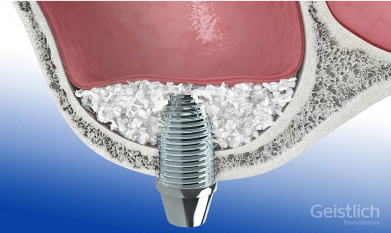 Sinus Augmentation