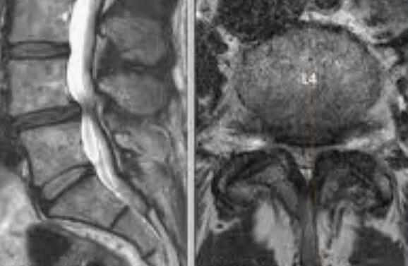 Lumbar Stenosis: 5 Must Know Facts
