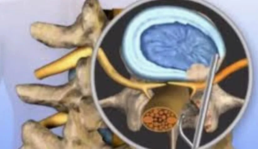 Minimally Invasive Low Back Surgery: A Potentially Misleading Term