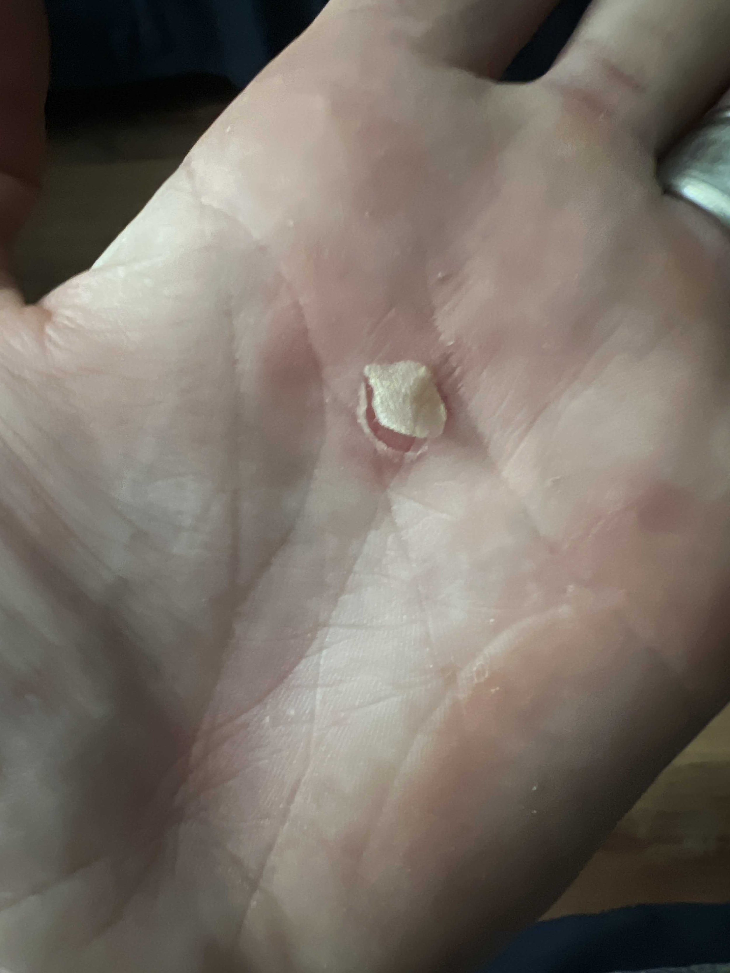  I was using my poles so much on the downhill that I gave myself a blister 