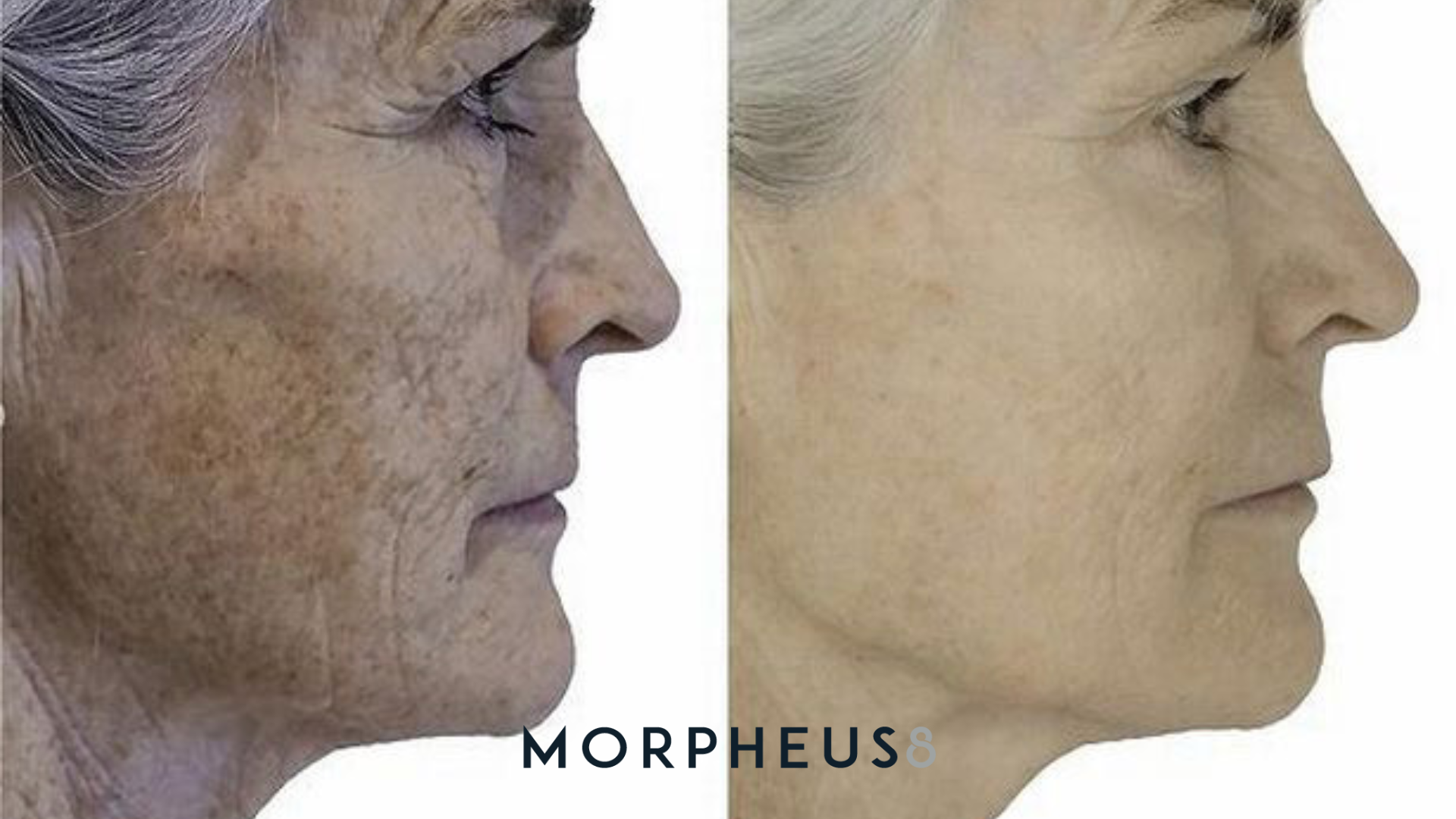Morpheus8 Before and Afters.png