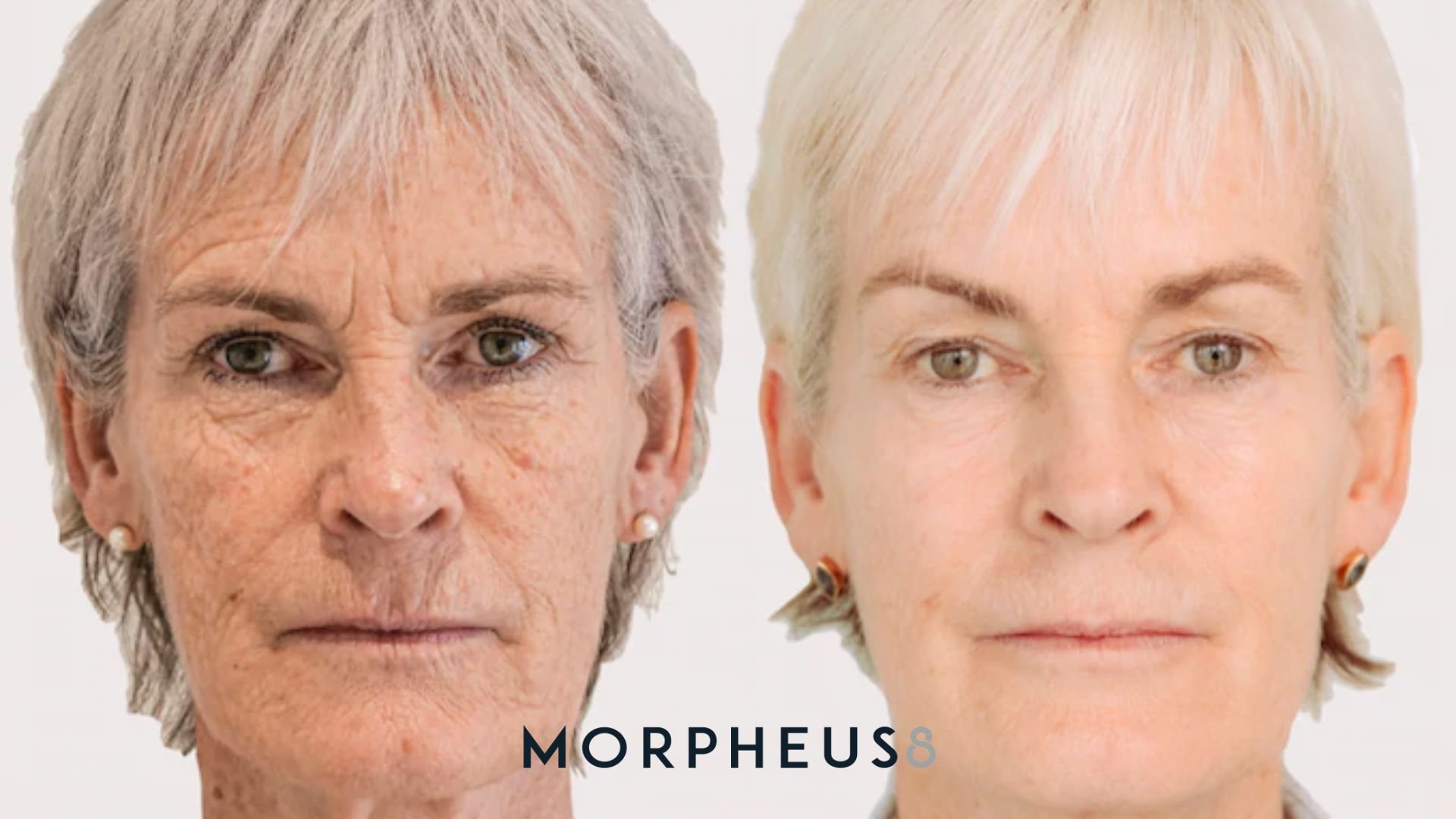 Morpheus8 Before and Afters.jpg