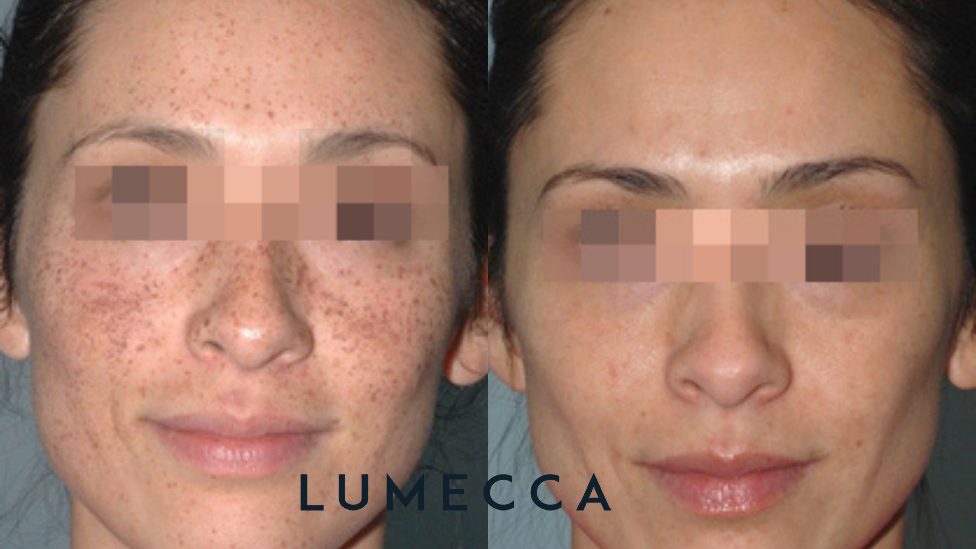 Lumecca Before and Afters (8).png