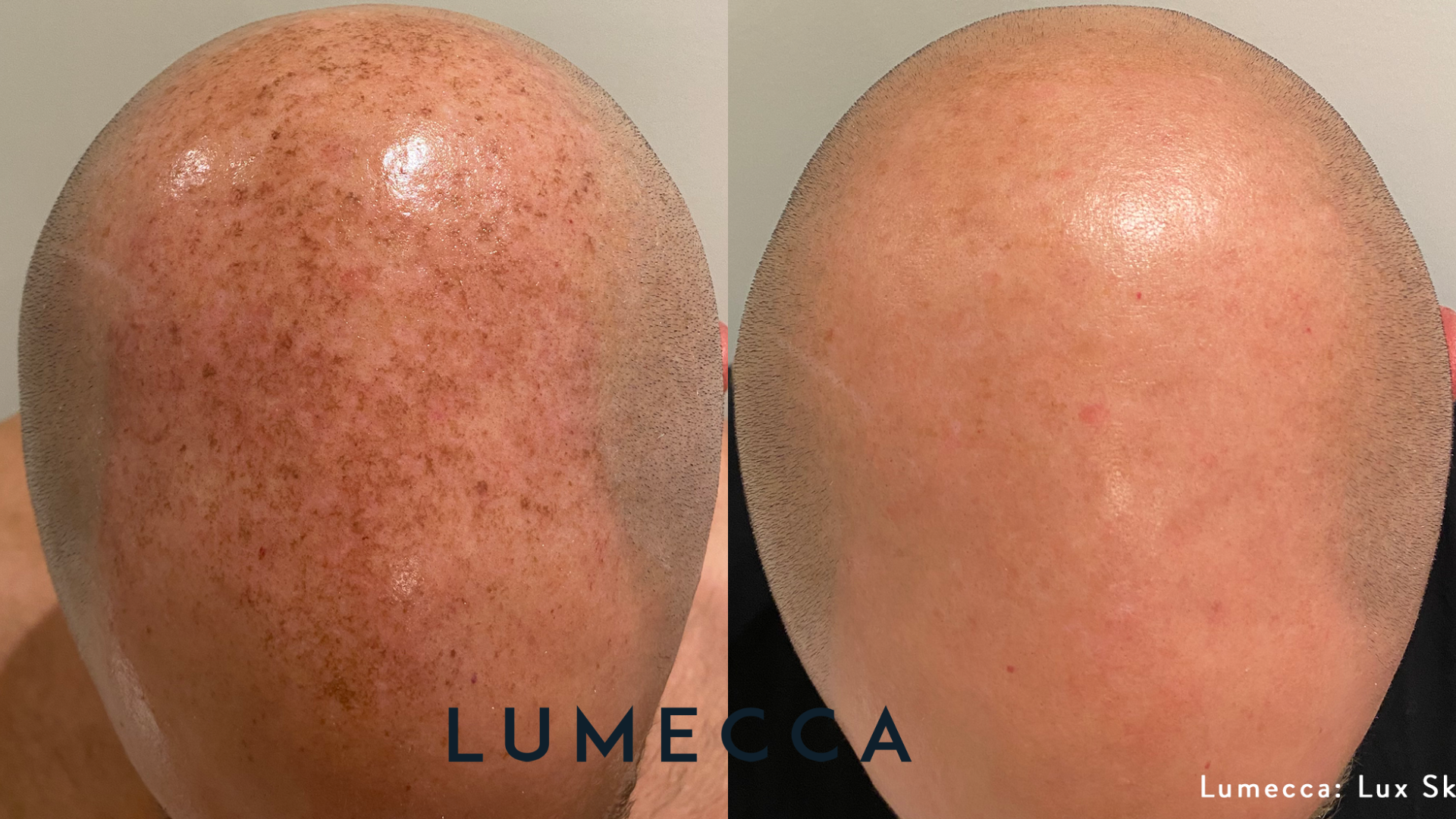 Lumecca Before and Afters (5).png