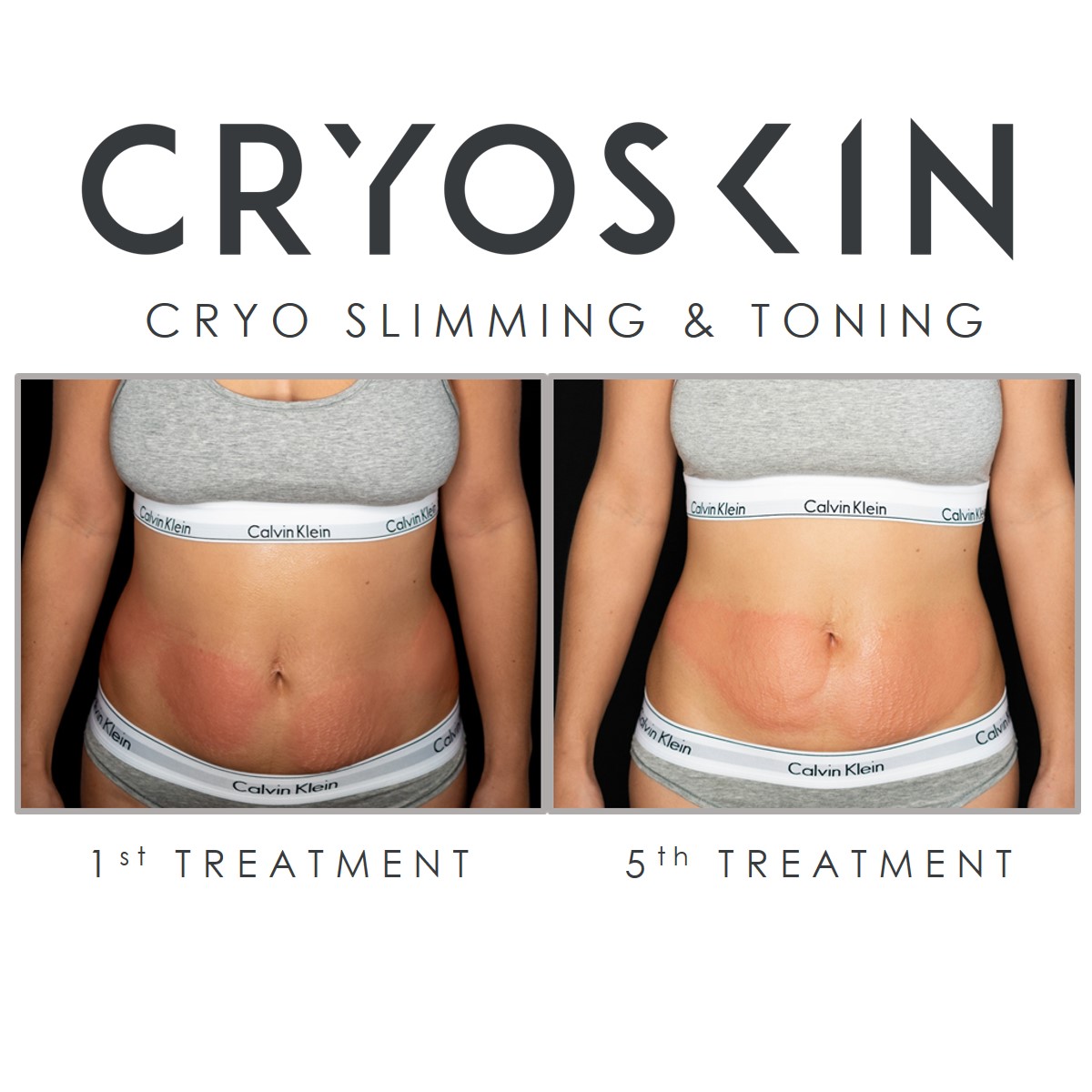 cryo slimming nyc)