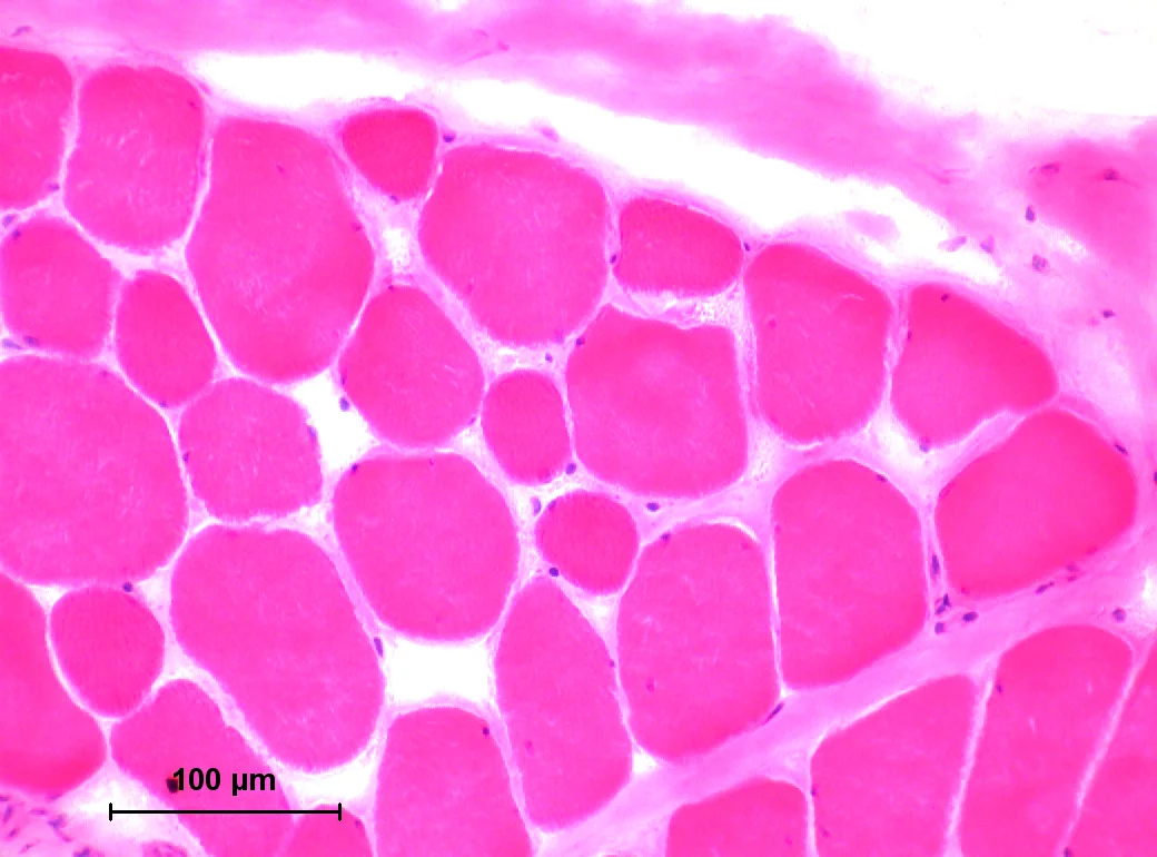 H&E of muscle biopsy