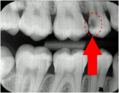 What Does Tooth Decay Look Like On An X Ray