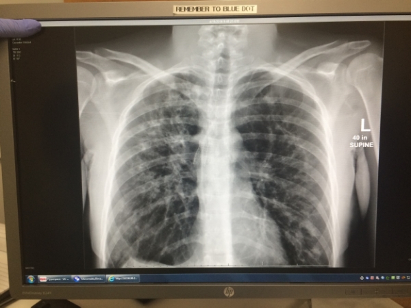 Rima's chest X-Ray