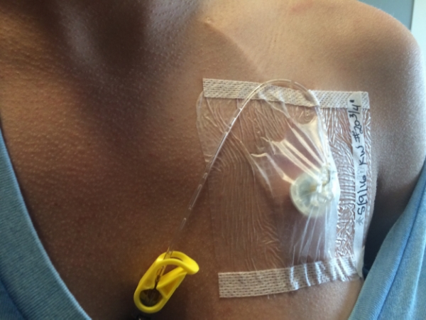 Port accessed, this is so the doctors can give her antibiotics through IV's. 