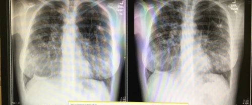 x-ray on the left is from Wednesday and the one on the right is from May