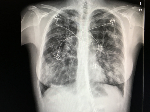 x-ray while still having leads on